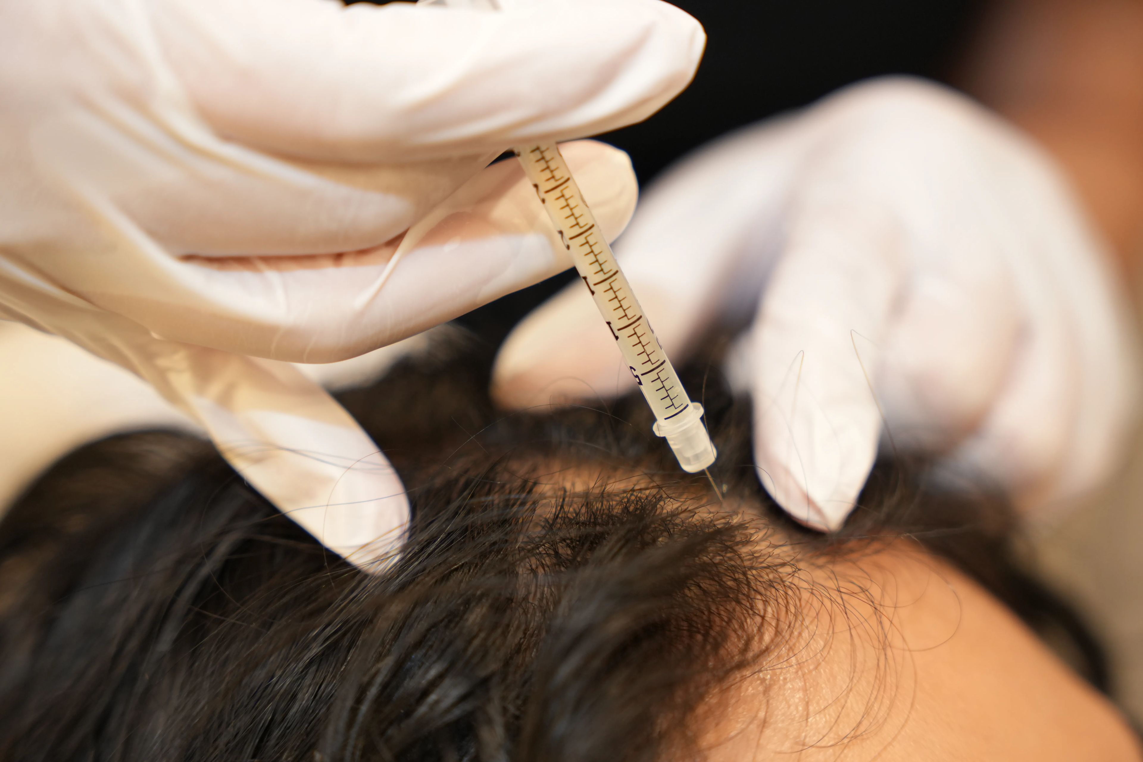 What to expect from PRP For Thick Hair & Scalp Health treatment at Toronto medical spa - treatment journey